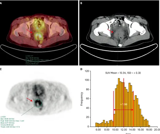 Fig. 1.  Positron emission tomography/computed tomography (PET/CT) (A), CT (B), PET (C) images, and three- three-dimensional (3D)-VOI based standardized uptake value (SUV)-histogram (D) for measurement of intratumoral [ 18 F]