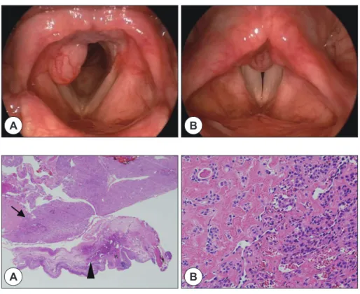 Figure 1. Laryngoscopic findings. 