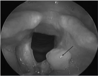 Figure 4. Laryngoscopic finding after 12 months of treatment Non- Non-pathogenic mucosa of larynx.