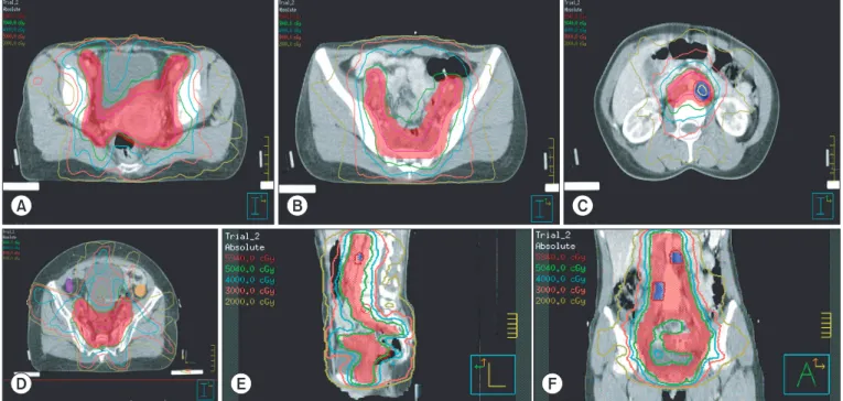 Fig. 2. The dose-volume histogram of  the extended field intensity-modulated  radiotherapy plan