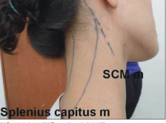 Fig. 15. 연축 사경에서 경련을 보이는 머리널판근splenius capitis mus- mus-cle, 흉쇄유돌근sternocleidomastoid muscle에 보툴리눔 독소를 주입 하게 된다