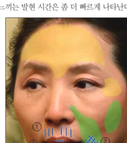 Fig. 1. Combination therapy of botulinum toxin type A and soft tis- tis-sue fillers in the upper face, where botulinum toxin type A is a  pri-mary modality of corrections
