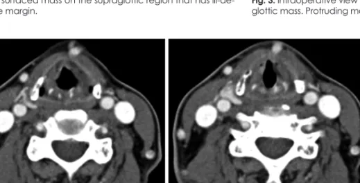 Fig. 3. Intraoperative view of larynx. Intraoperative view on supra- supra-glottic mass
