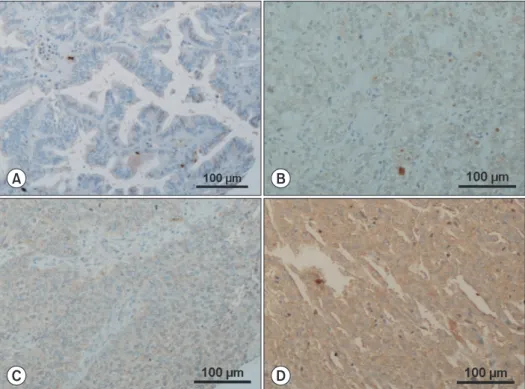 Fig. 1. Representatives of epidermal growth  factor-like domain 7 expression of each  grade in immunohistochemical staining  (×100)