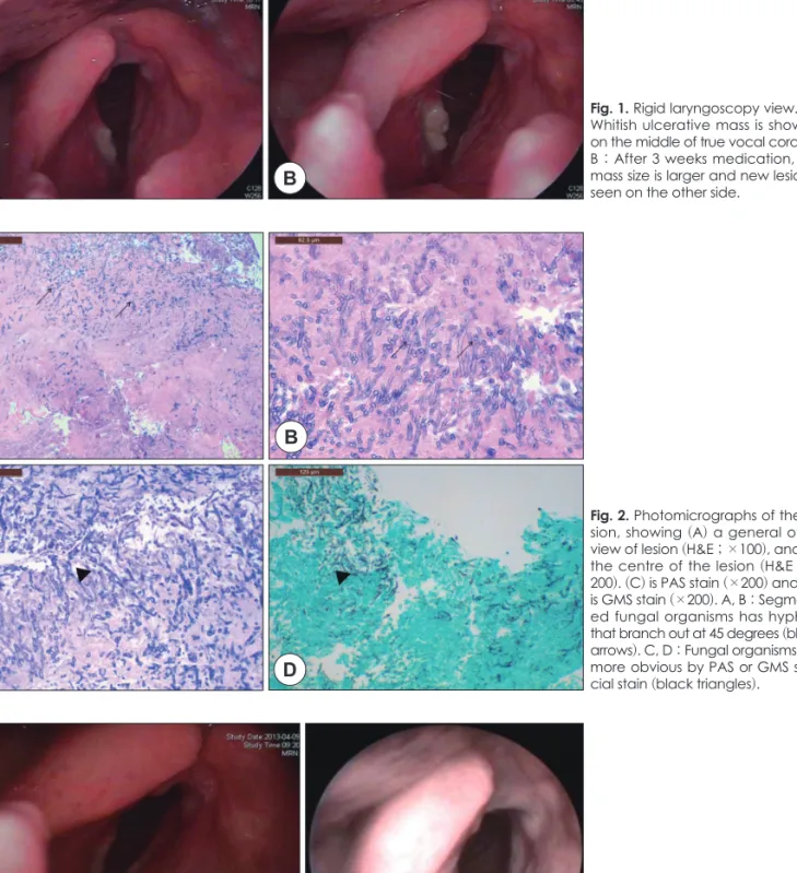 Fig. 3. POD 8 days (A) &amp; POD 4 mon- mon-ths (B) state. OP site are well healing  state and no complication.