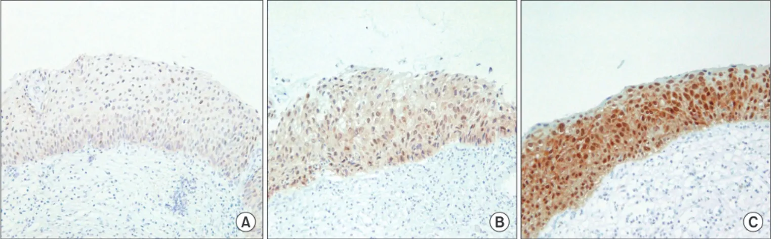 Fig. 2. p16 INK4a  immunohistochemistry of cervical biopsy specimens. Immunoreactivity for p16 INK4a  was classified as negative, weakly positive (A),  moderately positive (B), or strongly positive (C) (microscope objective: ×10).