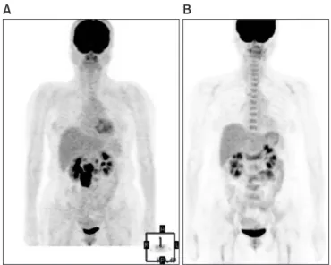 Fig. 2. (A) The initial CT showed huge  intra abdominal lym ph nodes encasing  the inferior vena cava and abdominal  aorta