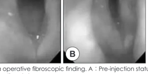 Fig. 5. Intra operative fibroscopic finding. A : Pre-injection status. 