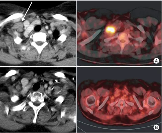 Fig. 4. Example of a case with right supra- supra-clavicular  lymph  node  metastasis  (A,  before treatment)