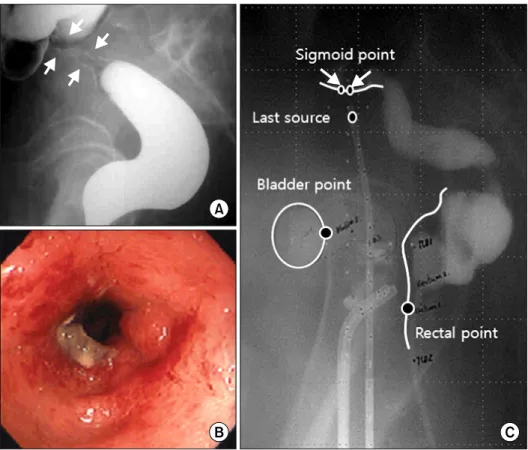 Fig. 1. Case 1: Lateral view (A) of a barium  enema study shows a stricture (between  arrows) of the sigmoid colon and  endo-scopy  shows  luminal  narrowing  and  friable  hyperemic  nodular  mucosal  changes (B)