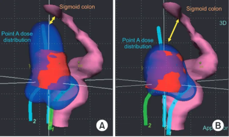 Fig. 3. Treatment planning with three dimensional (3D) image- image-based brachytherapy