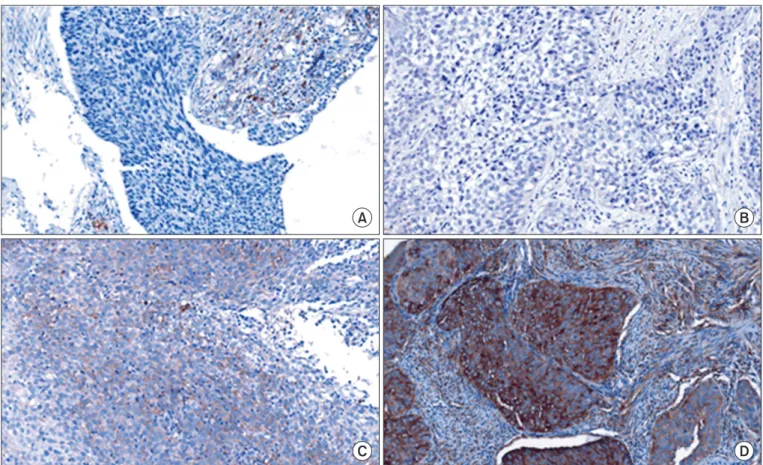 Fig. 1. Proportion score and intensity score examples of hypoxia inducible factor-2α expression (x200)
