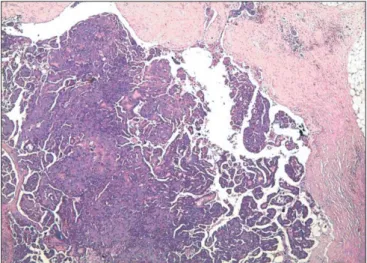 Fig. 1. Metastatic tumor nodule with evident papillary pattern in the  subcutaneous adipose tissue (H&amp;E, x40).