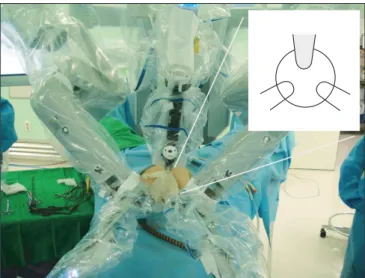 Fig. 3. Position of the robotic camera for robotic single-port transumbilical total hysterectomy to reduce collisions between the instruments  and camera