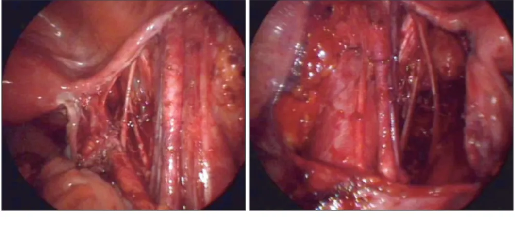 Fig. 4. Postoperative abdominal wall showing single three-channel  subumbilical incision and a suprapubic drain.