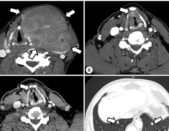 Fig. 1. Representative images of computed tomography (CT). A : Initial CT scan shows huge thyroid mass with homogeneous atten- atten-uation (white arrows)