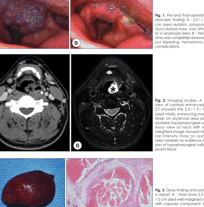 Fig. 1. Pre-and Post-operative en- en-doscopic finding. A : 2.5×1.5×1.5  cm sized reddish, polypoid,  pe-dunculated mass was attached  to Lt arytenoid area