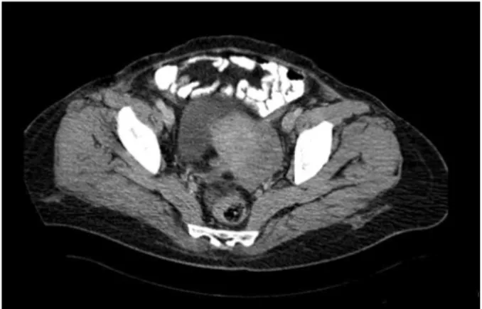 Fig. 1. Computerized tomography showing solid left adnexal mass.