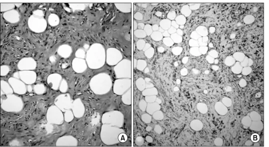 Fig. 2. Microscopic view of the tu- tu-mor demonstrating an admixture  of smooth muscle and adipose cells  on hematoxylin-eosin (×200) (A)  and positive staining with desmin  on immunohistochemistry (×100) (B).