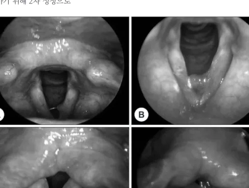 Figure 1. The endoscopic finding of  anterior vocal polyp and mid  vo-cal polyp. A : 2×1×1 mm sized  left anterior vocal polyp