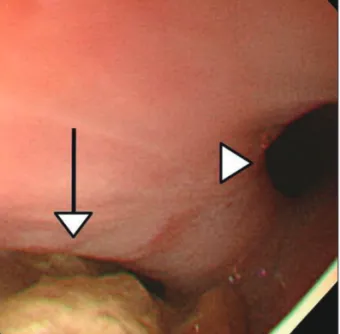 Figure 1. In the endoscopic image, diverticulum is located in the  left side of esophagus (white arrow)