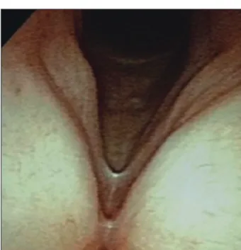 Figure 3. Postoperative endoscopic finding shows larynx just af- af-ter removal of polyp.