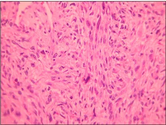 Fig. 2. The tumor composed of pleomorphic elongated spindle cells  with some conspicious nucleoli with eosinophilic fibrillar cytoplasm