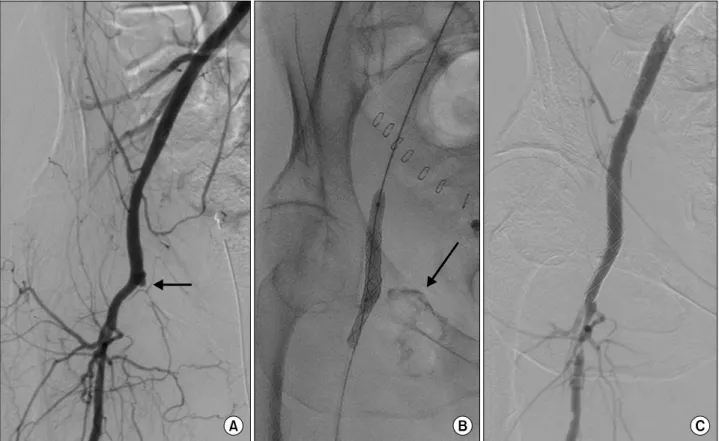 Fig. 1. (A) Occlusion of the superficial femoral artery at its origin (arrow). (B) Two 8 mm by 20 mm covered stents (Wallgraft TM  Endoprosthesis) deployed across the bifurcation of the common femoral artery into the profunda femoris artery, extravasation 