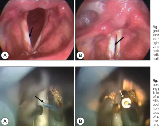 Fig. 1. Preoperative videolaryn- videolaryn-gostroboscopic examination. video  laryngeal stroboscopy shows  irregu-lar hyperkeratotic lesion including  right true vocal fold and left sulcus  vocalis