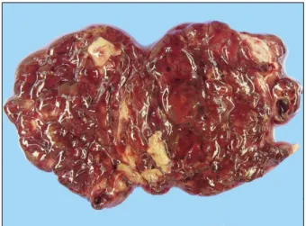 Fig. 3. Microscopic findings of the  left ovary. The sections of the left  ovary exhibit perivascular whorling  proliferation of plump and spindle  cells with a scanty cytoplasm and  indistinct cell borders (A,  hema-toxylin-eosin, ×200; B,  hematox-ylin-e