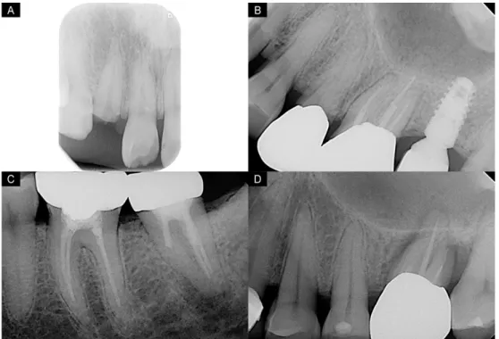 Fig. 1. Classification of radiographic features on periapical radiographs. (A) Grade 1, There is no periapical rarefaction around the root of