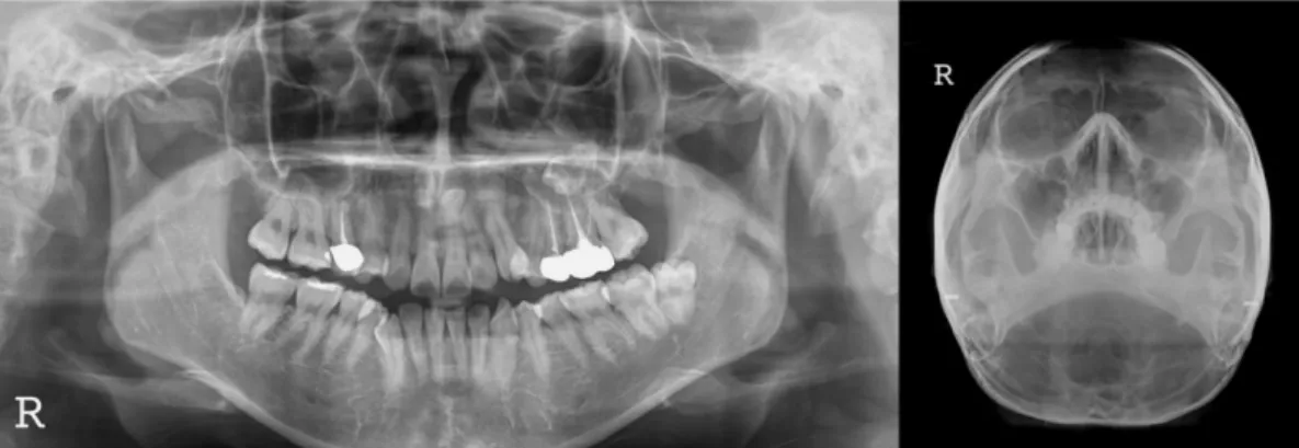 Fig. 1. Case 1: Displacement of the #28 tooth: Panoramic and occipitomental (Water’s) views taken at the first examination.