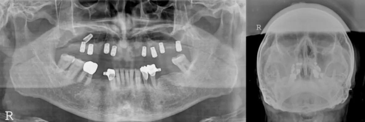 Fig. 4. Case 2: Displacement of the #17 implant: First CT.