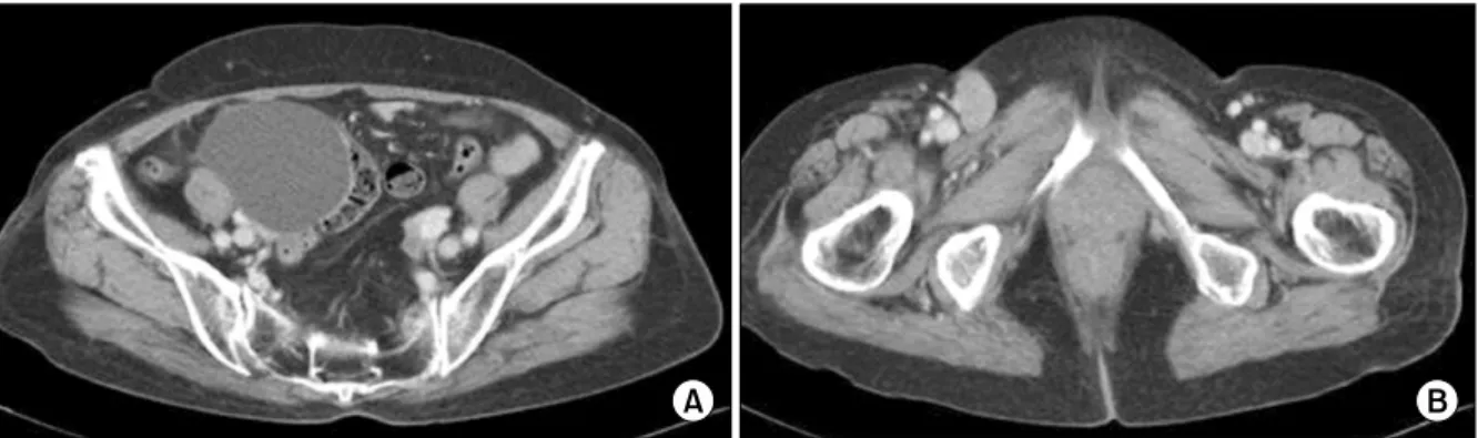Fig. 1. Colposcopic finding. It showed thin acetowhite epithelium  in 6 and 12 o'clock.