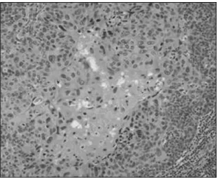 Fig. 4. Microscopic finding of inguinal lymph node. It showed squ- squ-amous cell carcinoma with keratin pearl (H-E stain, ×100).