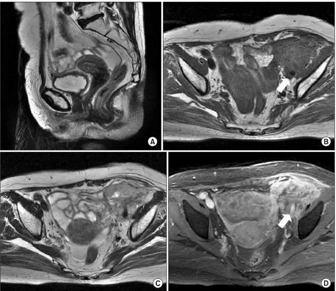 Fig. 1. Pelvic MRI showing a normal uterus (A), and about a 7.5×6.2×5.8 cm retroperitoneal irregular shaped heterogenous enhancing mass  that encased the  left external iliac vessels (B, C, D)