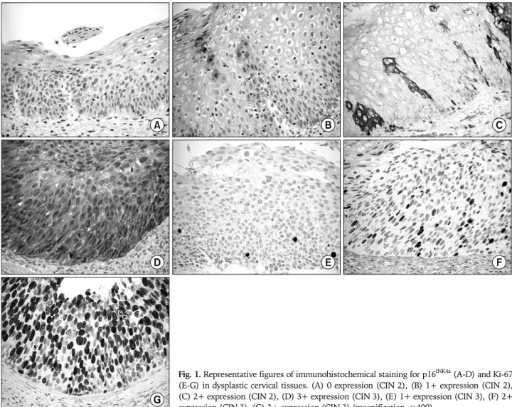 Fig. 1. Representative figures of immunohistochemical staining for p16 INK4a  (A-D) and Ki-67  (E-G) in dysplastic cervical tissues