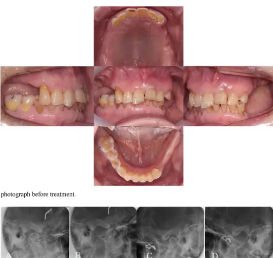 Fig. 3. TMJ series before treatment. (A) Rt. close, (B) Rt. opening, (C) Lt. close, and (D) Lt