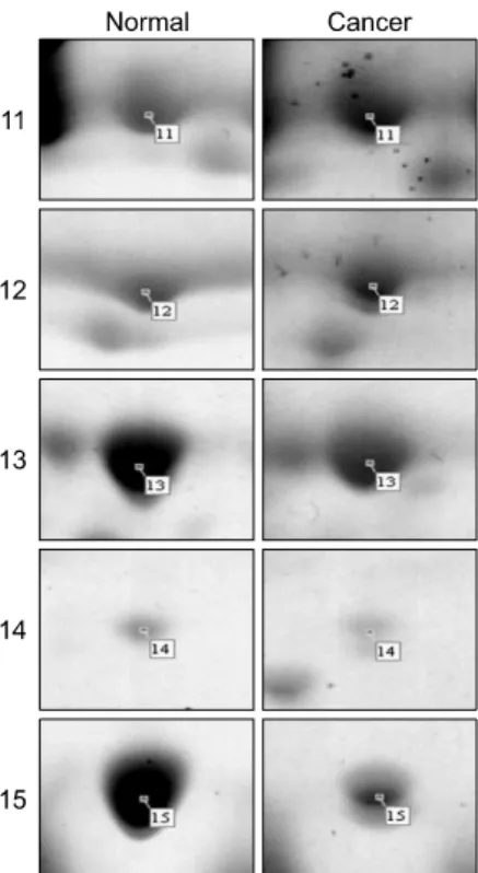 Fig. 2. (A) Enlarged 2-DE images  showing up- and down-regulation  of expression of plasma proteins  in squamous cell carcinoma of the  cervix compared to normal  cont-rols