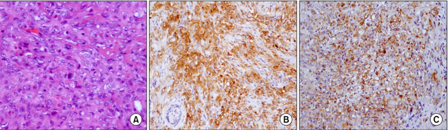 Fig. 2. Microscopic findings show epithelioid cells, spindle or polygonal cell components with atypia (A)(H&amp;E, ×400)