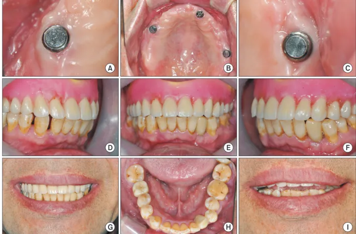 Fig. 3. (A–C) Magnetic attachment placed over #15, 22, 27 healing abutment. (D–F, H) Wax denture try-in