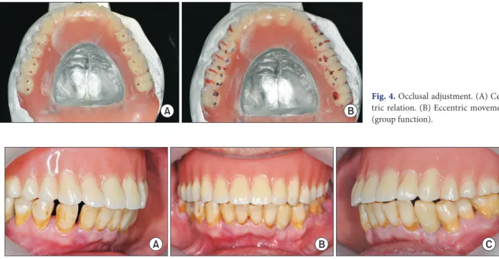 Fig. 4. Occlusal adjustment. (A) Cen- Cen-tric relation. (B) EccenCen-tric movement  (group function).