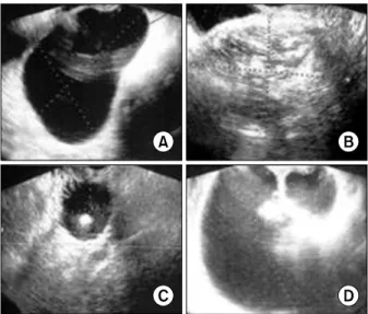 Fig. 4. The ROC curve excluding ovarian teratomas. A cutoff range  is a MI 6.5-7.5. It has a sensitivity 0.875-0.917 and a 1-specificity  0.046-0.138