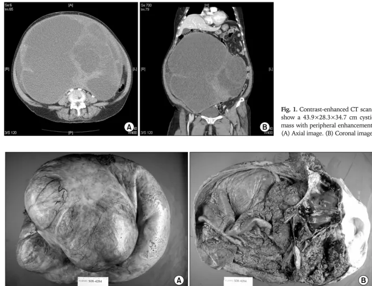 Fig. 1. Contrast-enhanced CT scans  show a 43.9×28.3×34.7 cm cystic  mass with peripheral enhancement