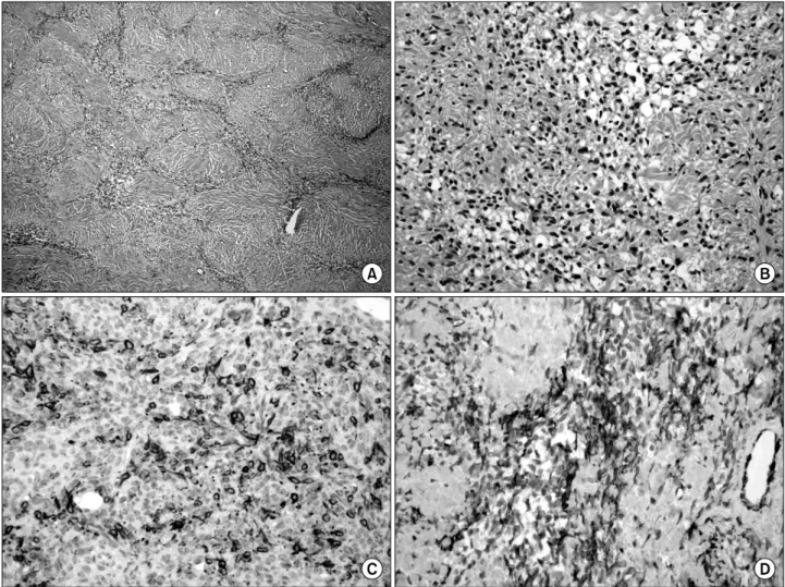 Fig. 3. Microscopic finding of viable area. (A) It shows an alternative pseudolobular pattern which consist of cellular and hypocellular areas  (H&amp;E, ×40)