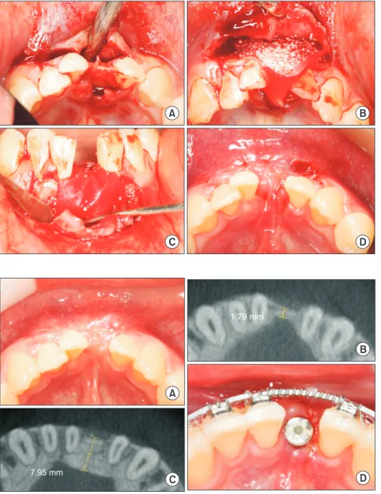 Fig. 2. Clinical photograph during  and after surgical procedure of case  1 patient. (A) After incision and flap  elevation, (B) bone graft application  with the cut barrier membrane in the  periosteum, (C) adaptation of the  barrier membrane, (D) after 2 