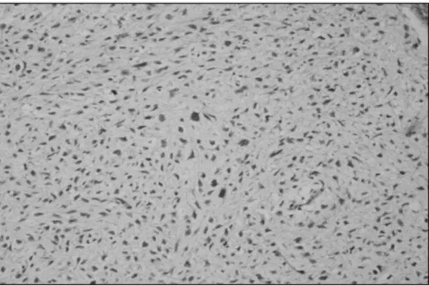 Fig.  4.  There  are  pleomorphic  spindle  cells  in  myxoid  background  (H&amp;E,  ×200).구 용적률 35%,  백혈구 21,690/mm3, 혈소판 398,000/mm3이었고, 간기능 검사, 혈액 응고 검사, 신장기능 검사, 생화학 검사 및 요 검사, 흉부 방사선 검사 및 심전도 검사는 모두 정상 소견이었다