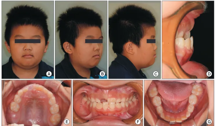 Fig. 2. Lateral cephalogram of the patient at first visit for the orth- orth-odontic consultation.