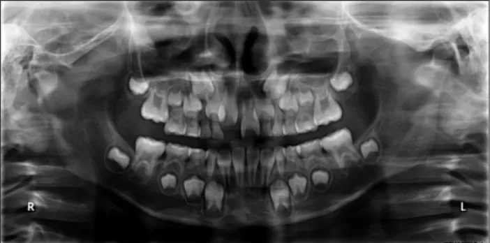 Fig. 4.  Intra-oral view of the rapid  palatal expander appliance with hooks  from face mask.