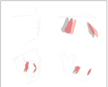 Fig. 11. Superimposition of lateral cephalometric measurements. An- An-terior crossbite has been resolved with improved esthetic line (black: 